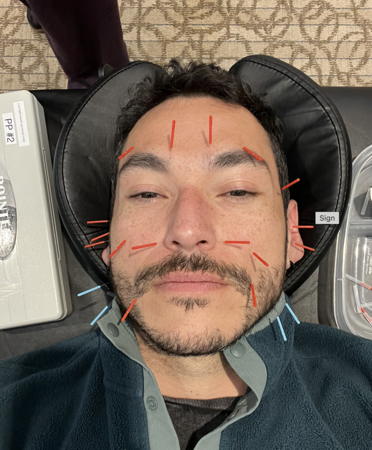 How a Personal Injury Led Me to Neurofunctional Acupuncture